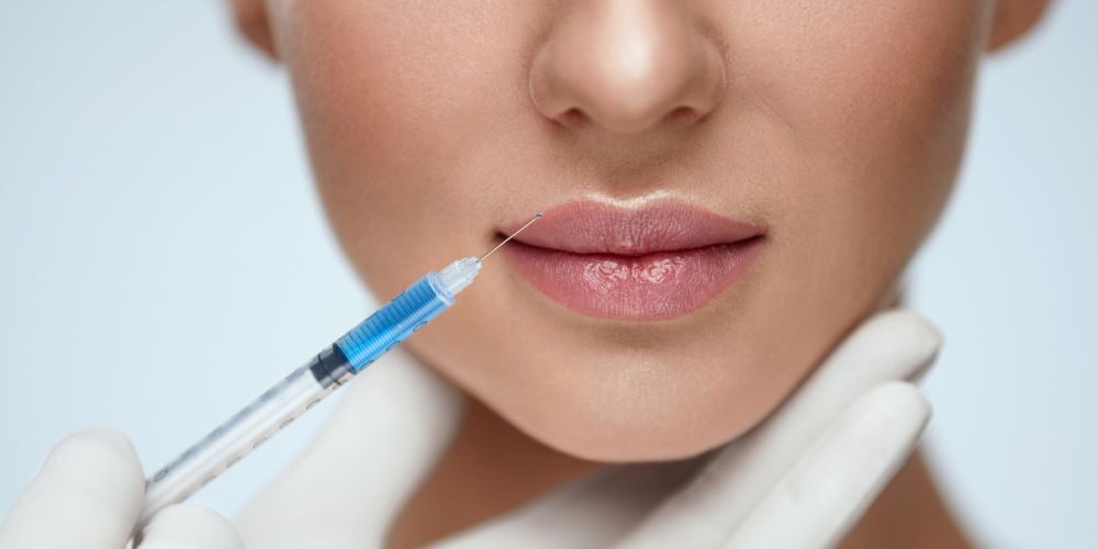 Filler labbra con tecnica russa a Catania