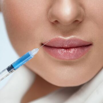 Filler labbra con tecnica russa a Catania